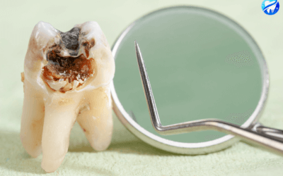 Comment prévenir les caries dentaires : conseils et astuces