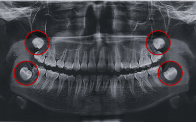 L’importance des dents de sagesse : À quoi s’attendre et quand les enlever ?