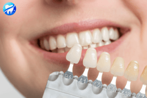 éclaircissement dentaire