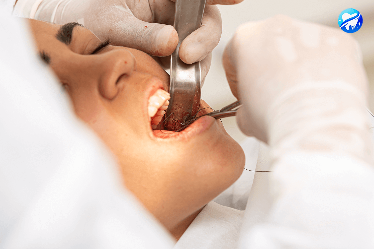 extraction dents sagesse