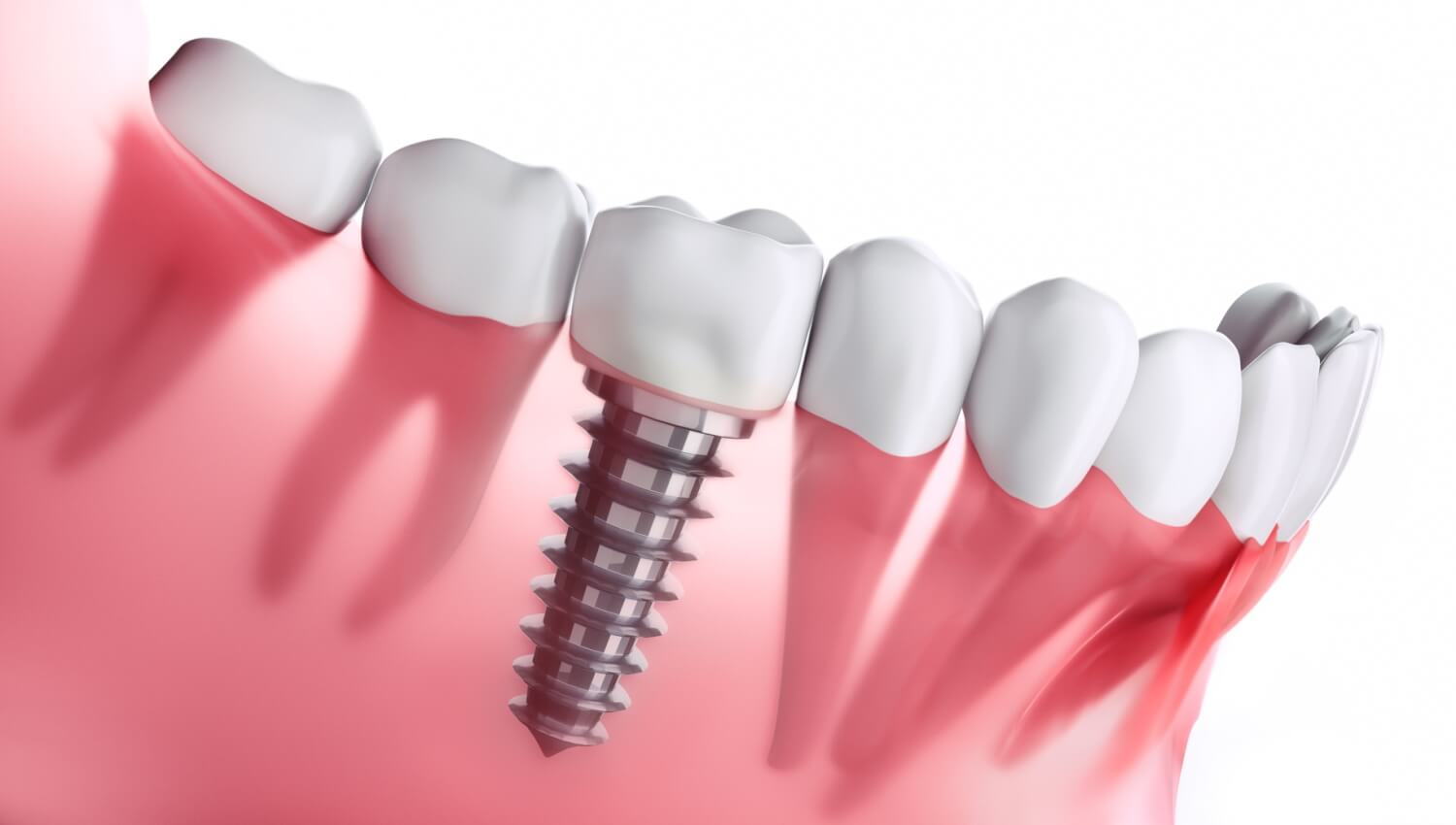 implant dentaire