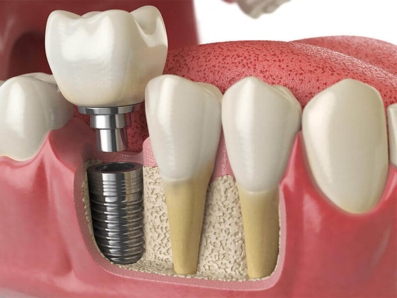 implantologie dentaire draveil