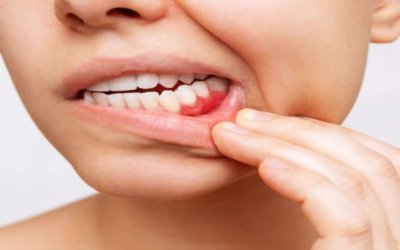 Bridges sur implants : une solution fixe pour remplacer plusieurs dents manquantes à Cagnes-sur-Mer