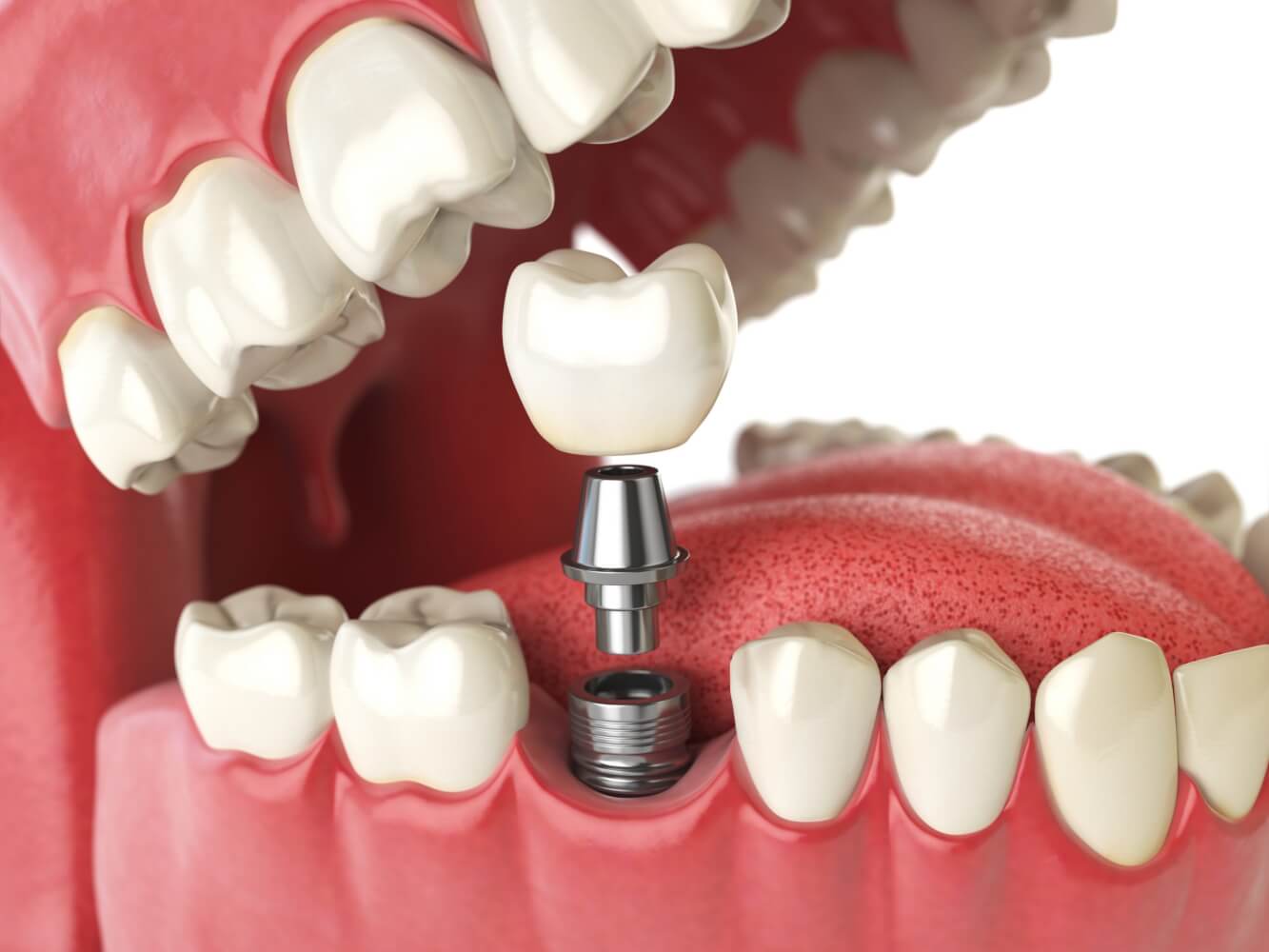 quels sont les differents types de protheses dentaires couronne sur implant scaled