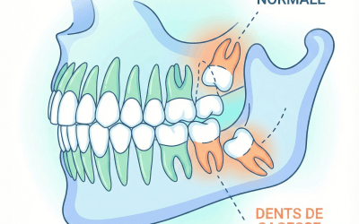 Dents de sagesse : quand et pourquoi les extraire ?