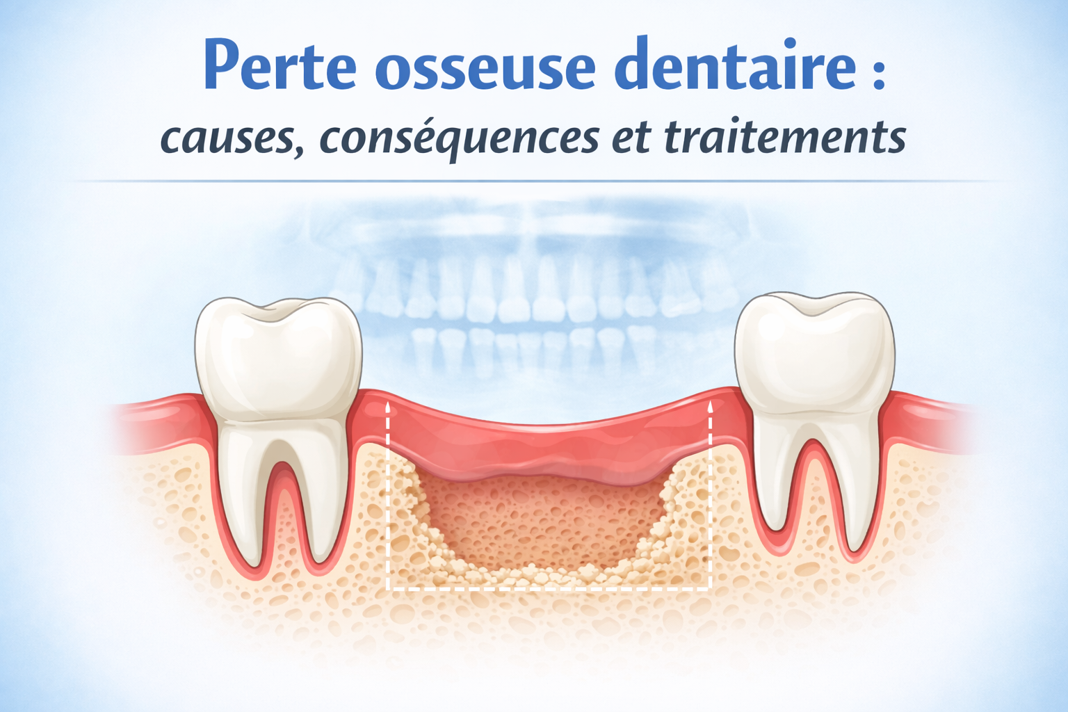 Perte osseuse dentaire Cagnes-sur-Mer : causes et traitements