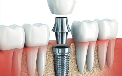 Pose d’implant dentaire à Cagnes-sur-Mer : étapes et conseils – Dr Lionel SELAM