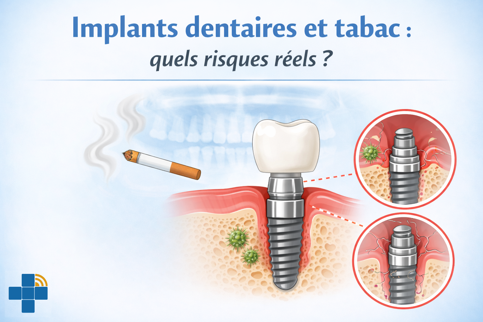 Dentiste expliquant les effets du tabac sur les implants dentaires