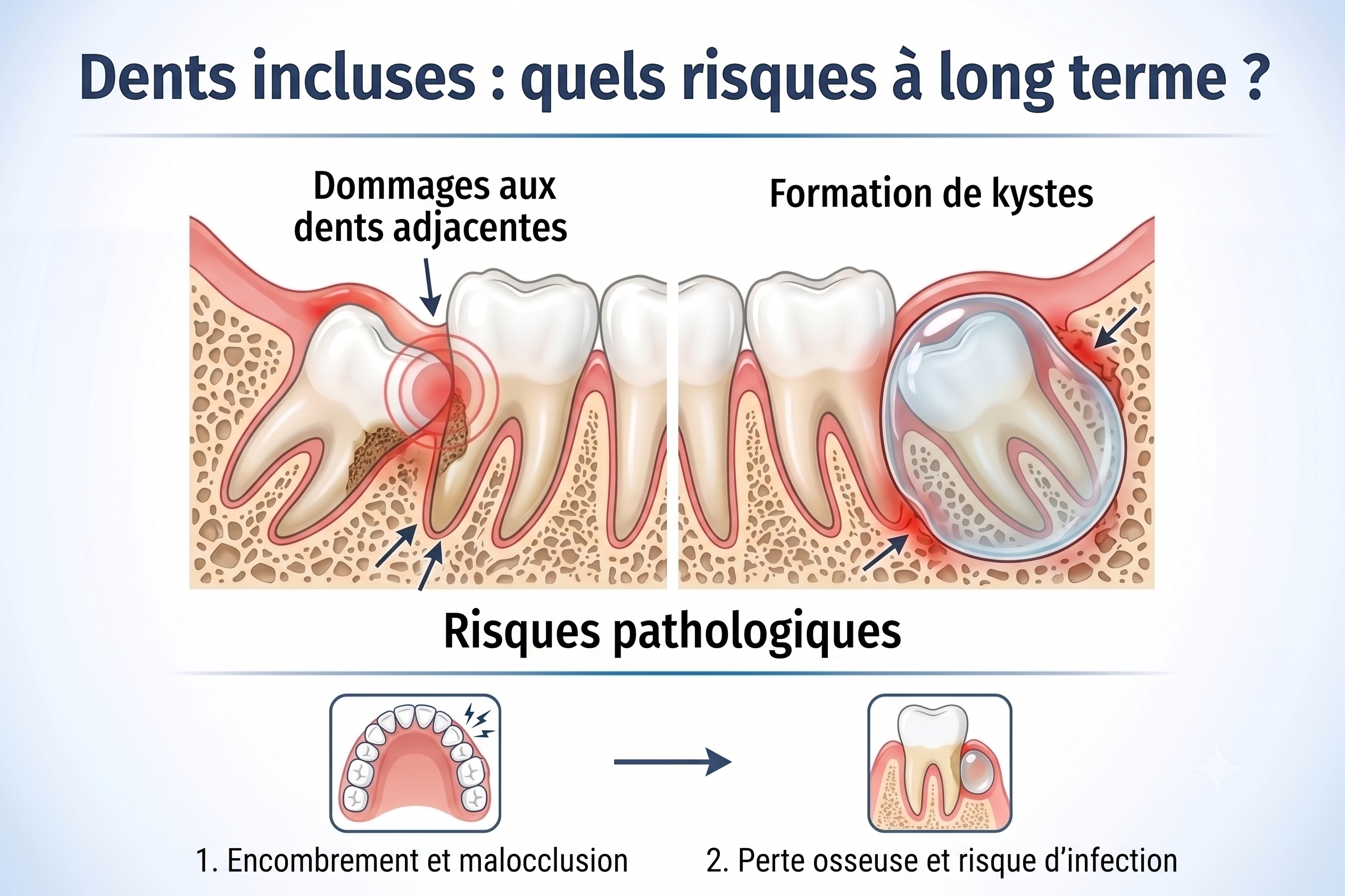 Dents incluses : quels risques à long terme ? | Dr Selam Un graphique décrivant les risques et la surveillance des dents incluses.