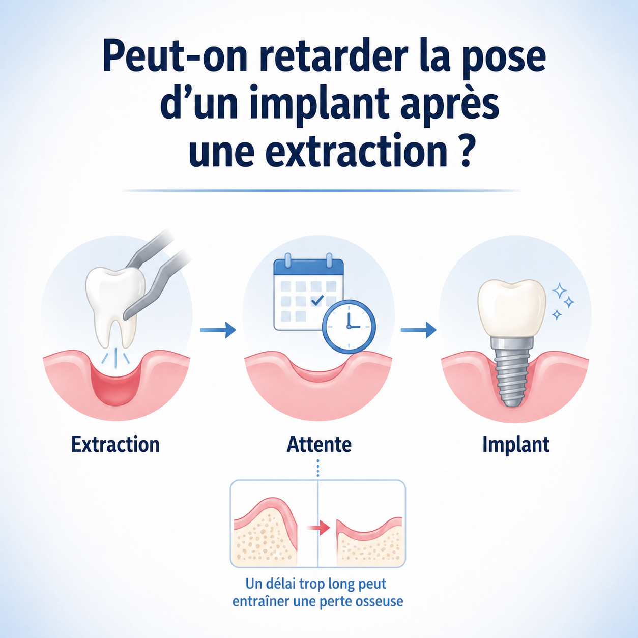 Peut-on retarder la pose d’un implant après une extraction ? | Dr Selam Image décrivant les étapes et considérations pour la pose d'un implant dentaire après une extraction.